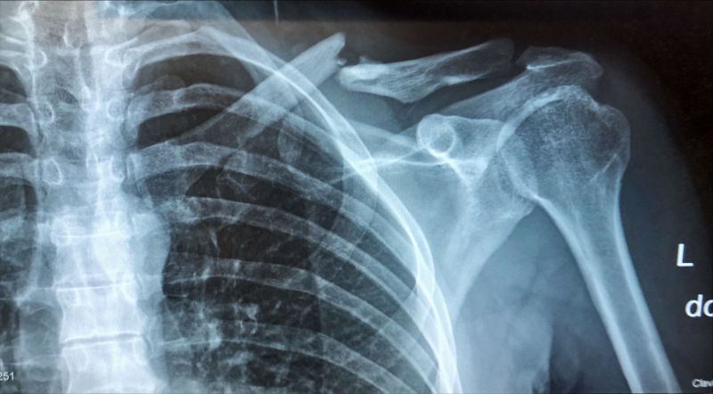 File:Broken collarbone-Jane H.jpeg